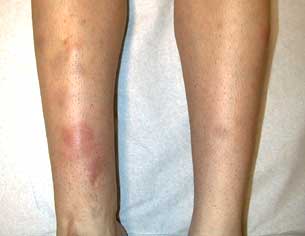  erythema nodosum